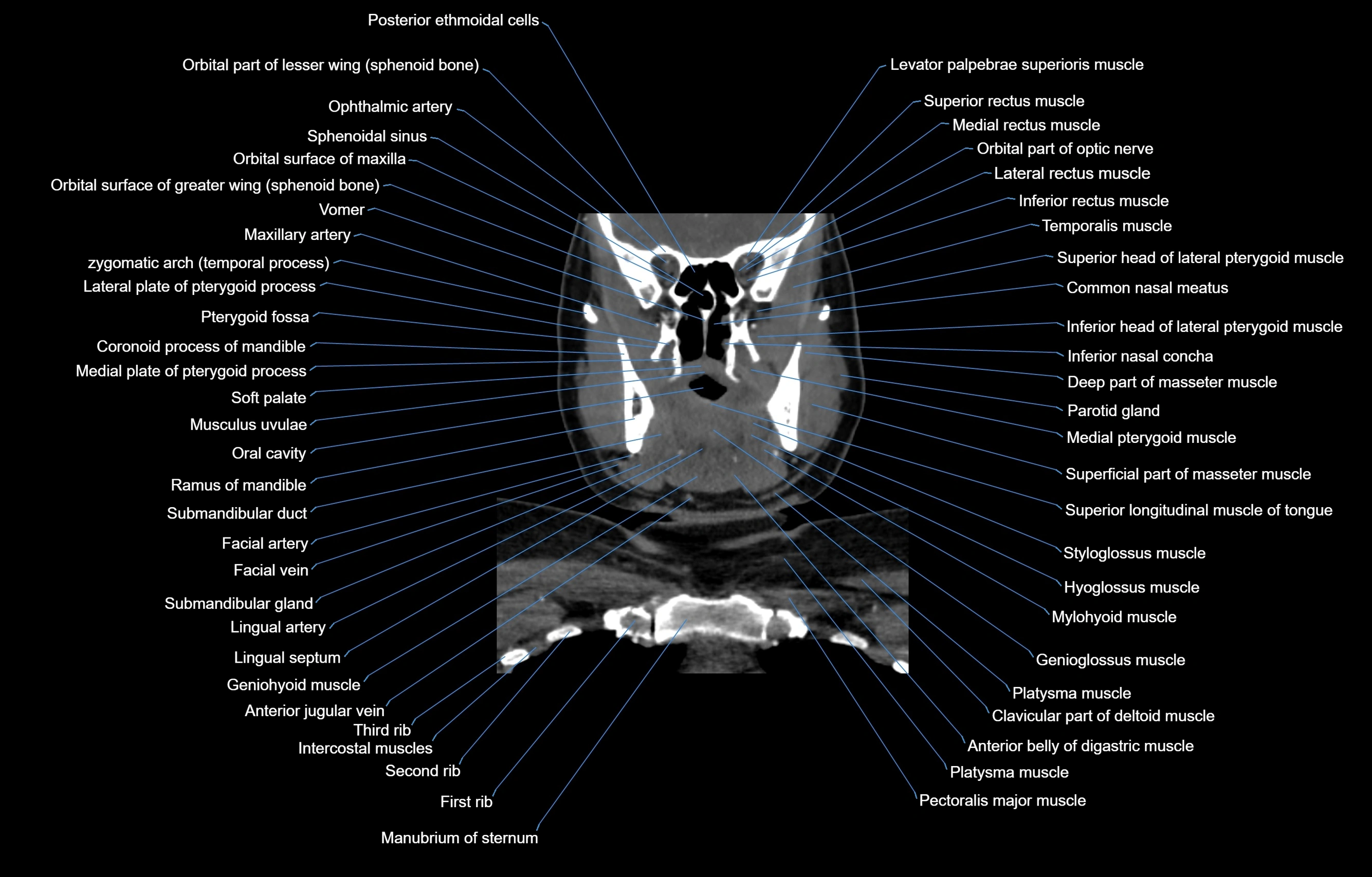 CT Neck coronal  cross sectional anatomy labelled 3D  radiology  image-00024.webp
